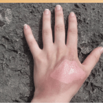 Scorching Summers Put Arizonans at Risk of Severe Burns