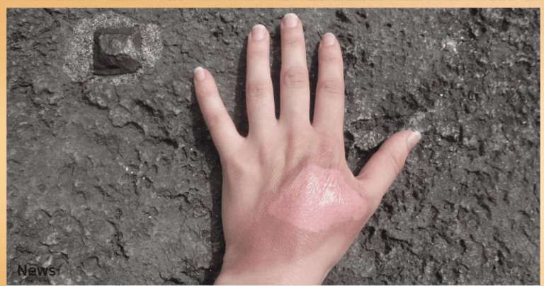 Scorching Summers Put Arizonans at Risk of Severe Burns